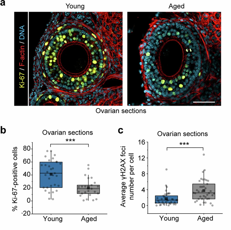 卵泡積累與年齡相關的異常 卵泡積累與年齡相關的異常