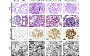 Nature子刊：首次揭示肝炎和腎損傷之間的聯系