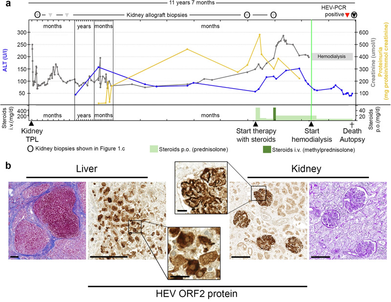 
戊型肝炎腎移植受者膜增殖型免疫復(fù)合物腎小球腎炎的臨床過程、尸檢結(jié)果和逐漸發(fā)展