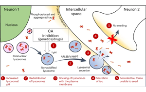 劍橋大學：青光眼藥物可能有助于預防阿爾茨海默病相關的tau蛋白積聚