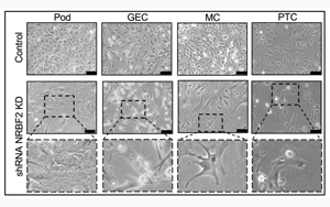 Nature子刊：糖尿病腎病的新靶點可預防終末期腎衰竭