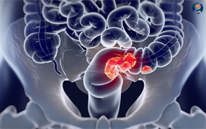 Nature｜華大攜手瑞典烏普薩拉大學(xué)發(fā)表全球最大規(guī)模結(jié)直腸癌多組學(xué)研究