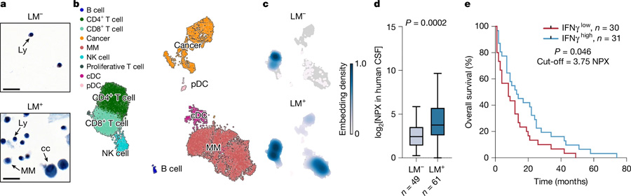 炎癥誘導的腦脊液細胞增多見于軟腦膜轉移患者 炎癥誘導的腦脊液細胞增多見于軟腦膜轉移患者