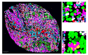 腫瘤微環境分析發現肺癌的治療應答標志物