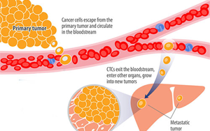 Nature Medicine一項開創性的新研究可防止乳腺癌復發