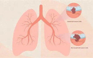 DNA甲基化與基因組改變協(xié)同驅(qū)動非小細胞肺癌演化的機制研究