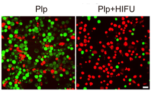 HIFU驅(qū)動靶向細胞焦亡治療基底樣乳腺癌：從基因篩選到血小板膜雜交脂質(zhì)體的協(xié)同機制探索