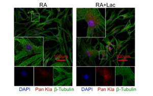 組蛋白乳酸化修飾通過(guò)上調(diào)NFATc2表達(dá)及抗乳酸化組蛋白自身抗體促進(jìn)類風(fēng)濕關(guān)節(jié)炎進(jìn)展