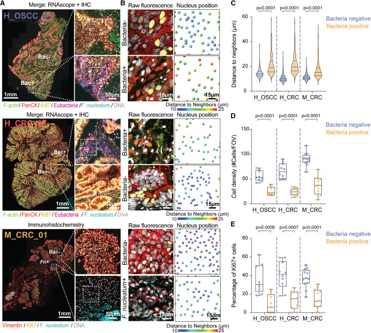 細菌感染微灶內癌細胞的空間分布