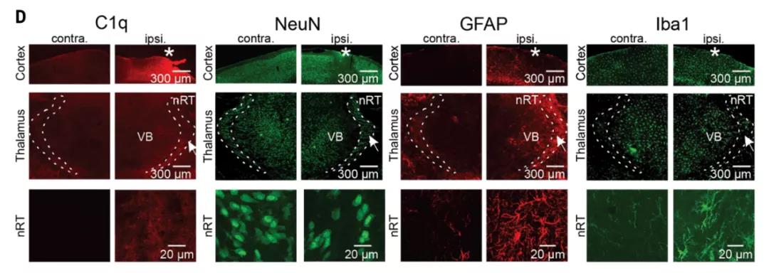 顱腦創傷后的繼發性腦損傷是怎么發生的？Science：補體介導炎癥及神經損傷！