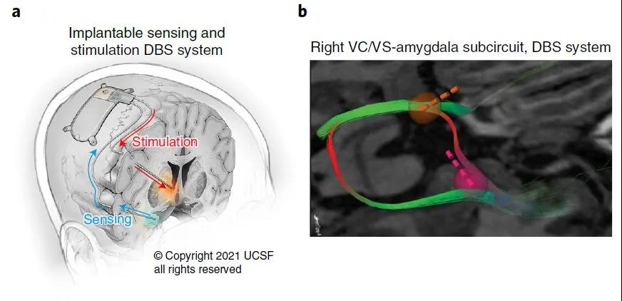 腦電刺激成功拯救重度抑郁癥患者，治愈抑郁癥時(shí)代離我們不遠(yuǎn)了？