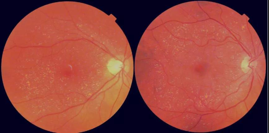 眼睛竟是“年齡之窗”？視網(wǎng)膜年齡差距或可預(yù)測(cè)壽命長(zhǎng)短