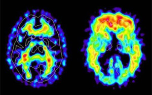 新冠帶來新的“醫療壓力”：阿爾茨海默病的風險飆升50%-80%
