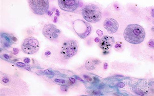 Science Immunology：巨噬細胞發育缺陷導致肺部疾病