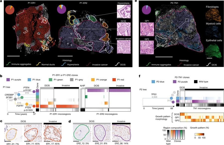 由三位原發性乳腺癌患者的組織學檢測繪制的遺傳克隆圖 由三位原發性乳腺癌患者的組織學檢測繪制的遺傳克隆圖