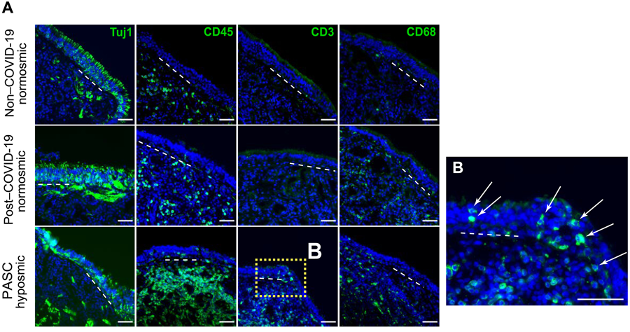 新冠肺炎急性后遺癥嗅覺粘膜下丘組織學評估提示T細胞浸潤的作用