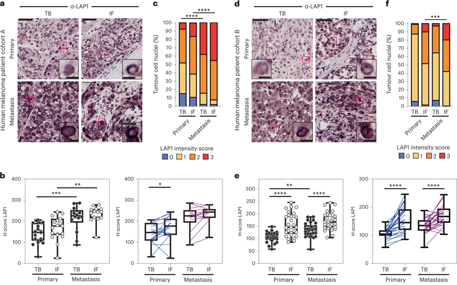 LAP1水平在人類黑色素瘤進展中增加