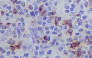 早期預測CAR-T細胞治療反應的新生物標志物