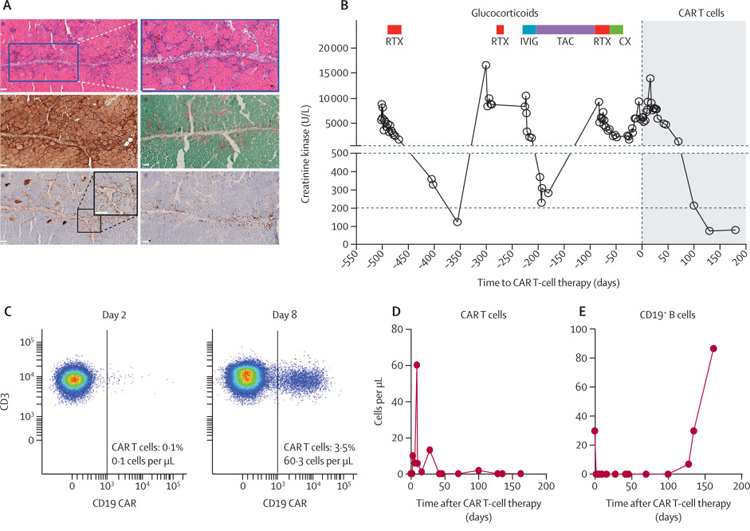 CAR T細胞對抗突觸綜合征表現的影響