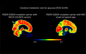 Nature Medicine發現了新的基因變異，可以預防阿爾茨海默病