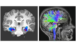 Nature Medicine：一種新的強迫癥神經生物標志物