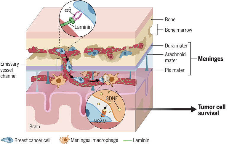 乳腺癌細(xì)胞轉(zhuǎn)移和在腦脊膜的促生交互 乳腺癌細(xì)胞轉(zhuǎn)移和在腦脊膜的促生交互
